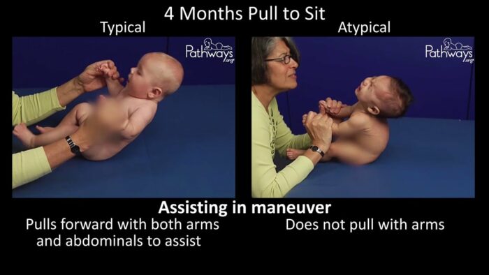 Pathways.org | 4 Month Old Typical/Atypical Motor Development  – Side by Side Comparison